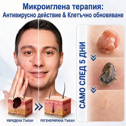 🇧🇬 Качествено българско производство, бърза вътрешна доставка | MURWON® 🌥️ Лепенки с микроигли за намаляване проявите на несъвършенства по кожата 🥦 (При кожни израстъци, брадавици, бенки, пигментни петна и други видими кожни дефекти.) 🖤